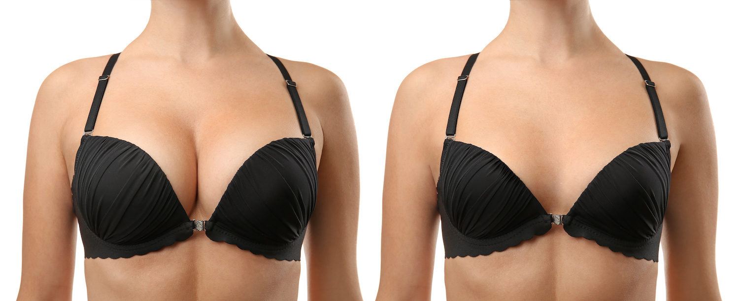 Breast Augmentation, Cosmetic Surgery